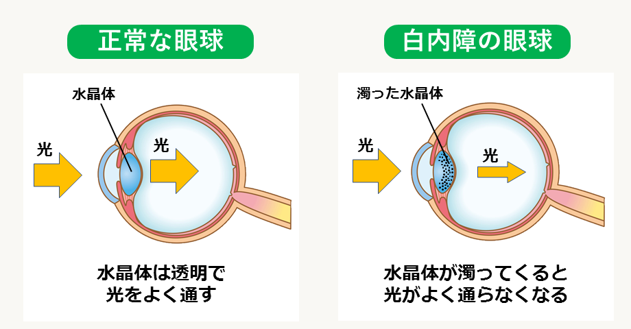 正常眼球と白内障眼球の比較